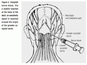 Occipital_Nerve_Block
