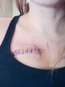 I call this one the "Tijuana Boob Job"