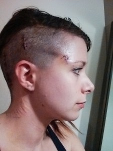 Sutures in the front, staples in the back.